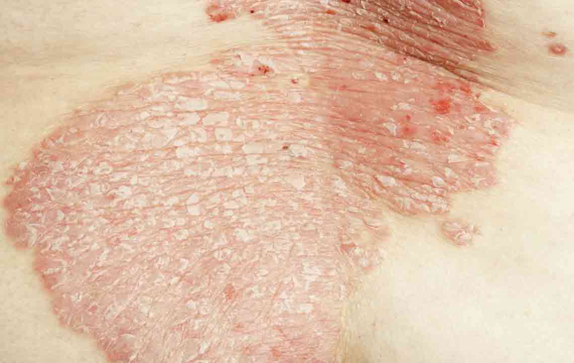 7 Common Types of Eczema