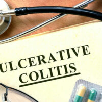 Beating Ulcerative Colitis Flares