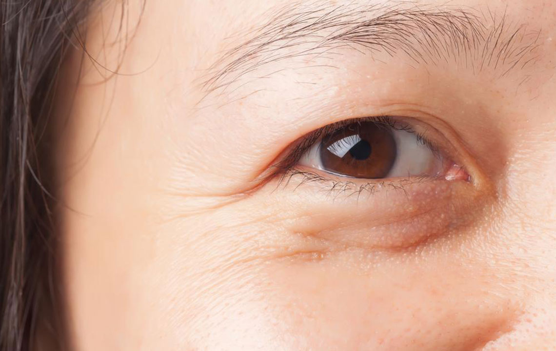 Causes of Under Eye Bags and Their Treatments