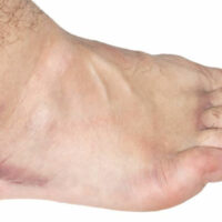 Get Easy Relief from Your Swollen Ankle