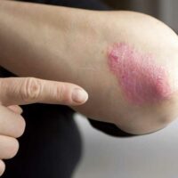 Home Remedies to Manage the Symptoms of Psoriasis