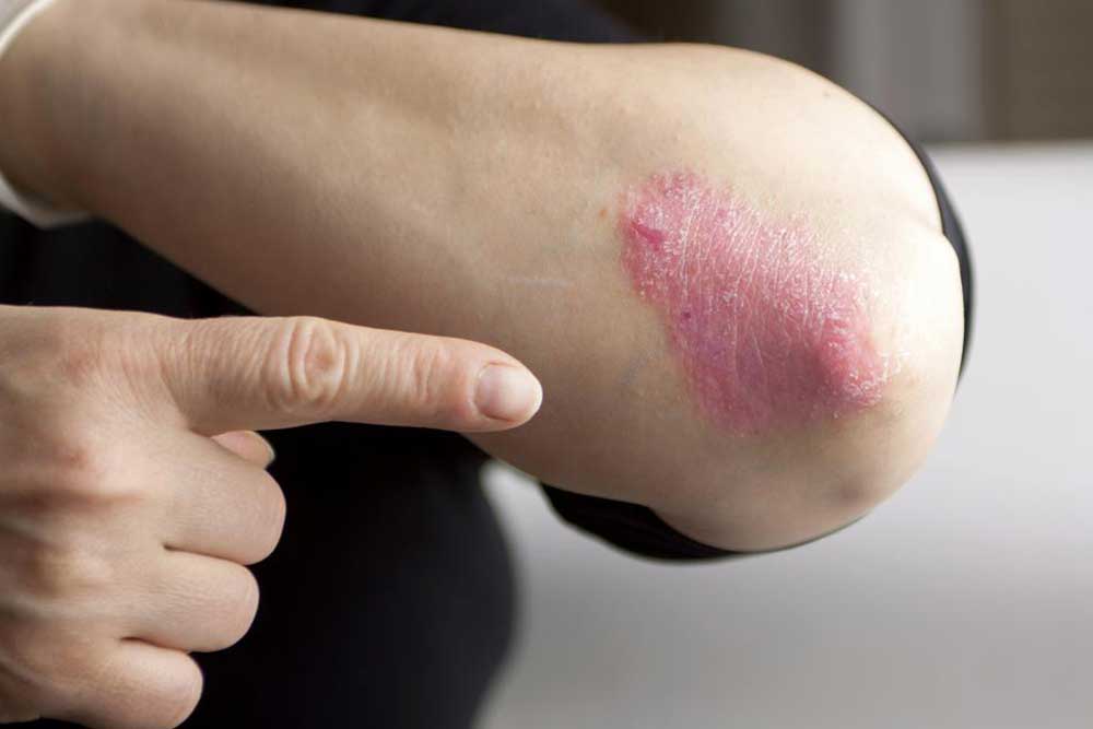 Home Remedies to Manage the Symptoms of Psoriasis