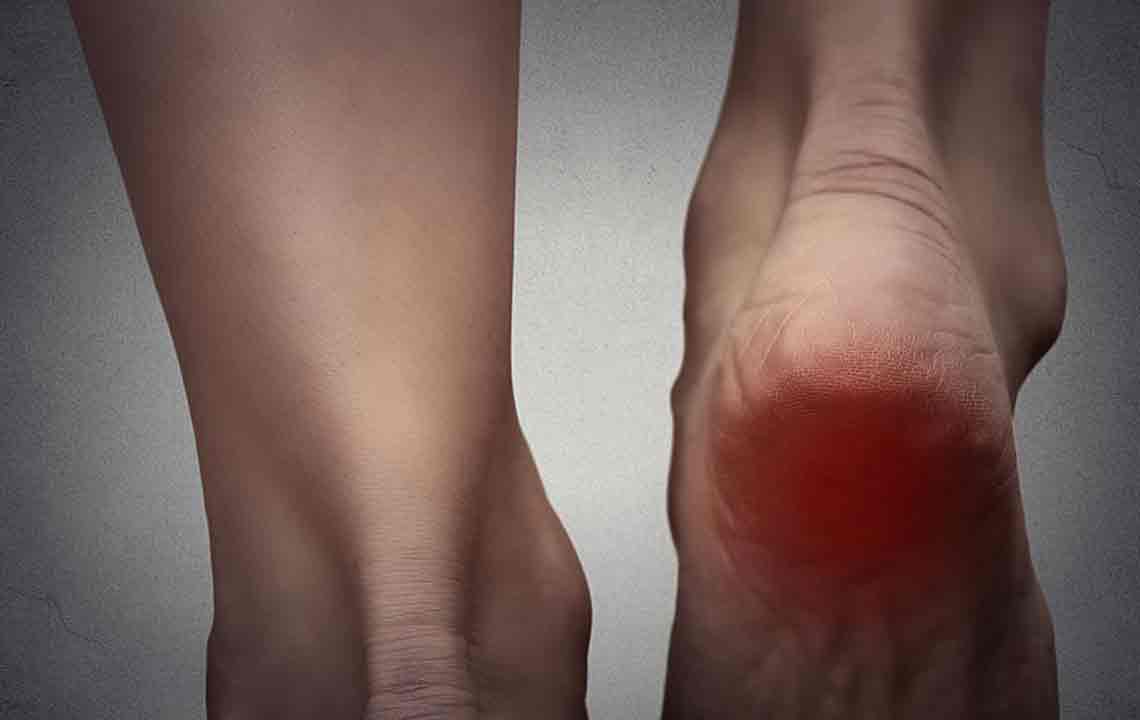 Simple Treatment Options for Gout