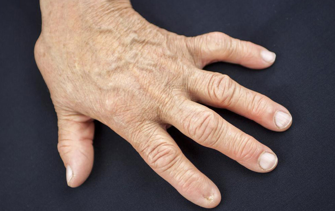 Signs of Rheumatoid Arthritis You Should Look out For