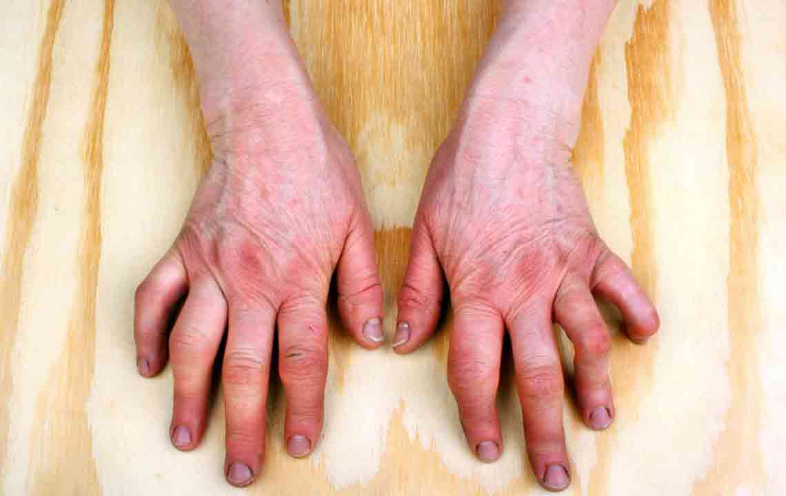 Understanding the Symptoms of Rheumatoid Arthritis