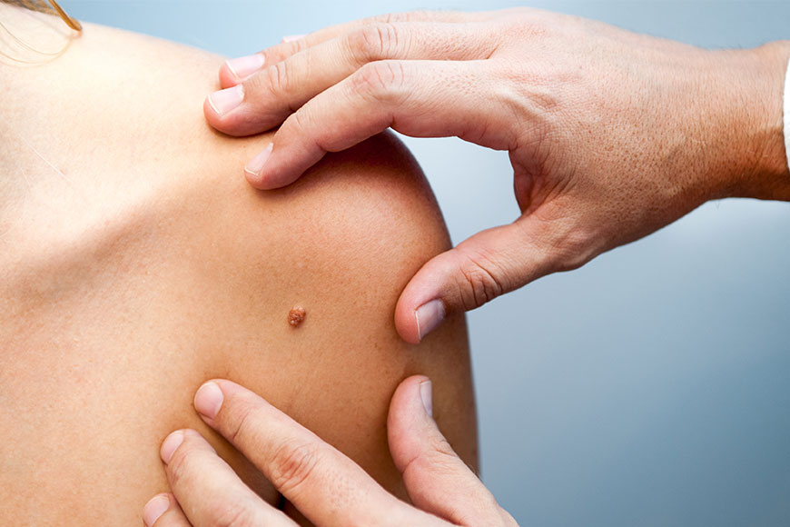 6 early signs of skin cancer