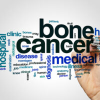 6 warning signs of bone cancer that demand therapy