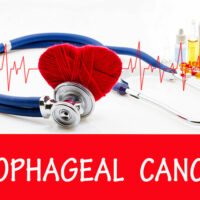 6 warning signs of esophageal cancer