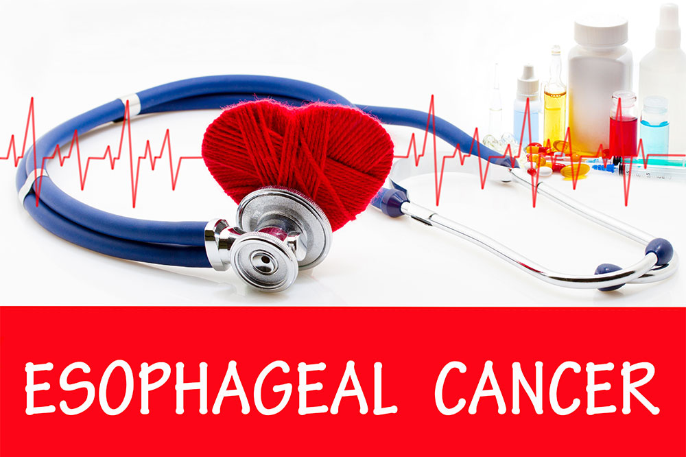 6 warning signs of esophageal cancer